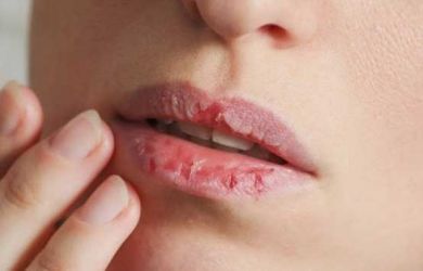 Ini Tips Merawat Bibir Kering Saat Puasa di Bulan Ramadhan