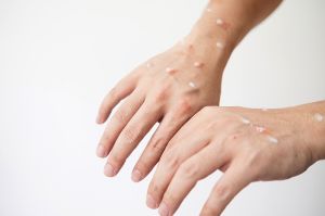 Diduga Meninggal Akibat ‘Cacar Monyet’, Kemenkes Ungkap Fakta Sebenarnya